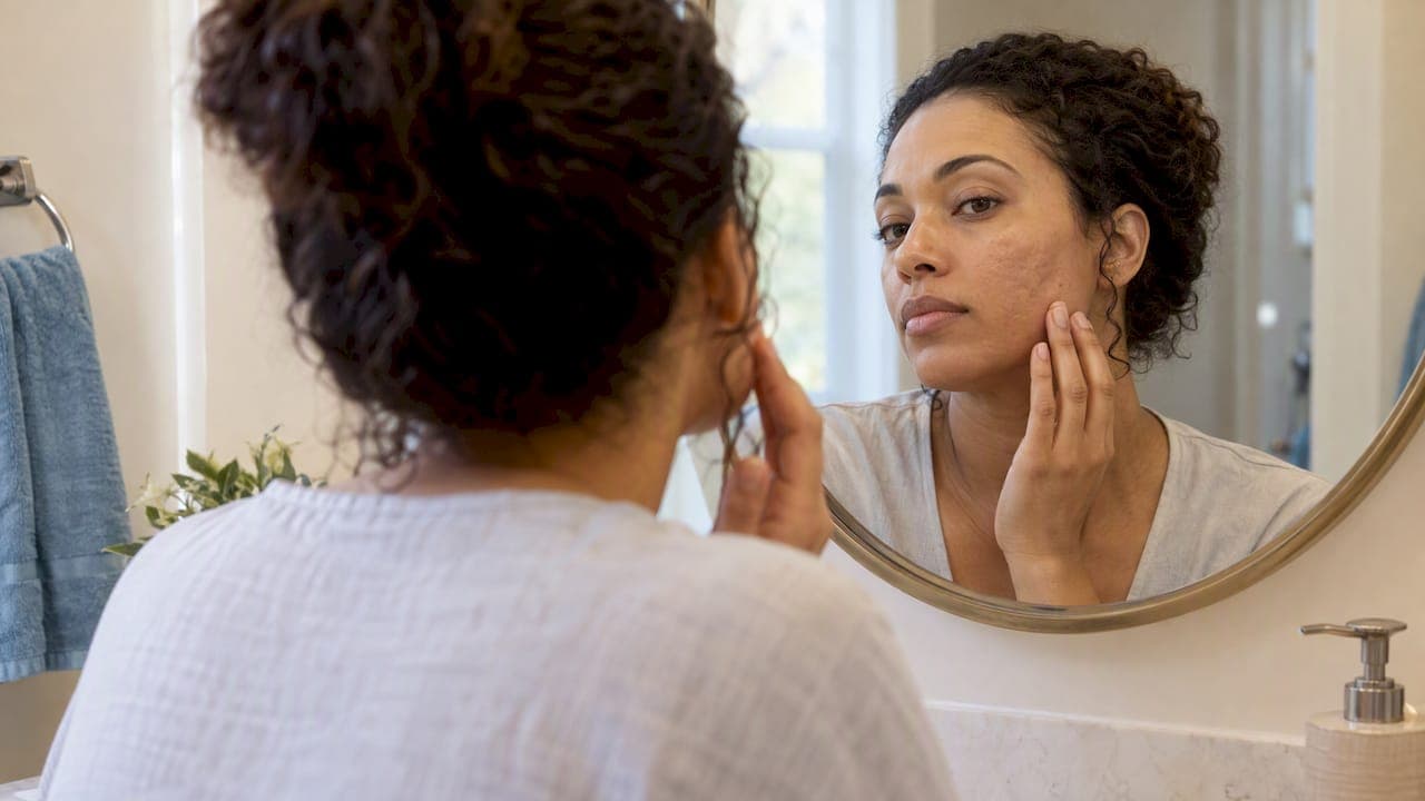 Chemical Peels for Acne Scars in Stony Brook: What to Expect